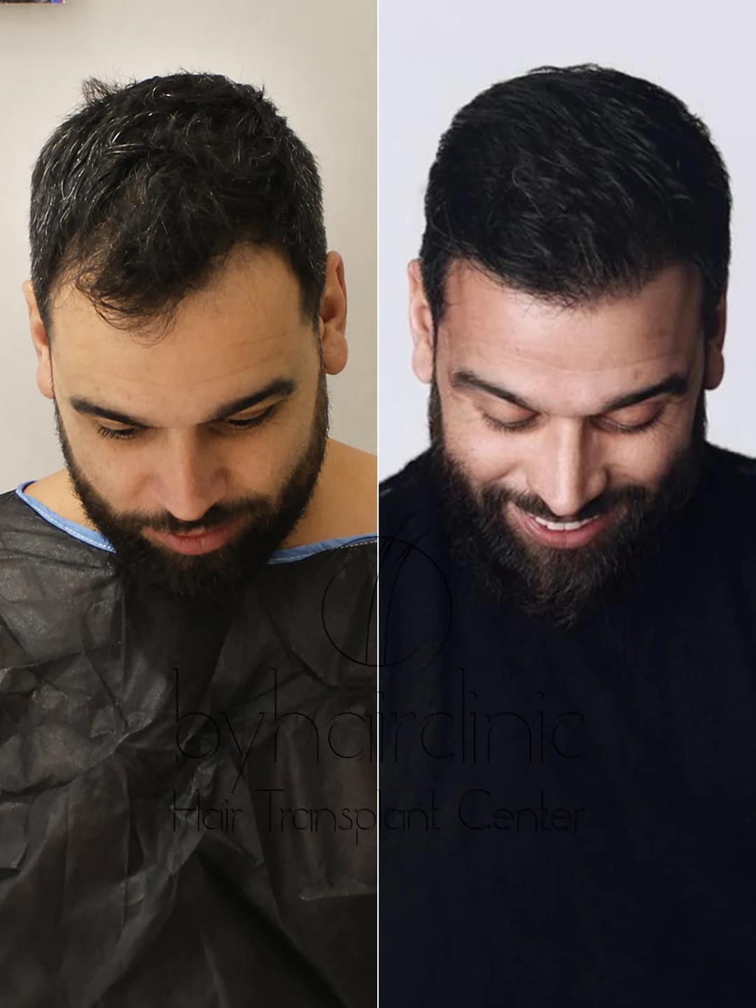 Avant et après la greffe de cheveux de Noré Abdelali réalisée chez byhairclinic à Istanbul