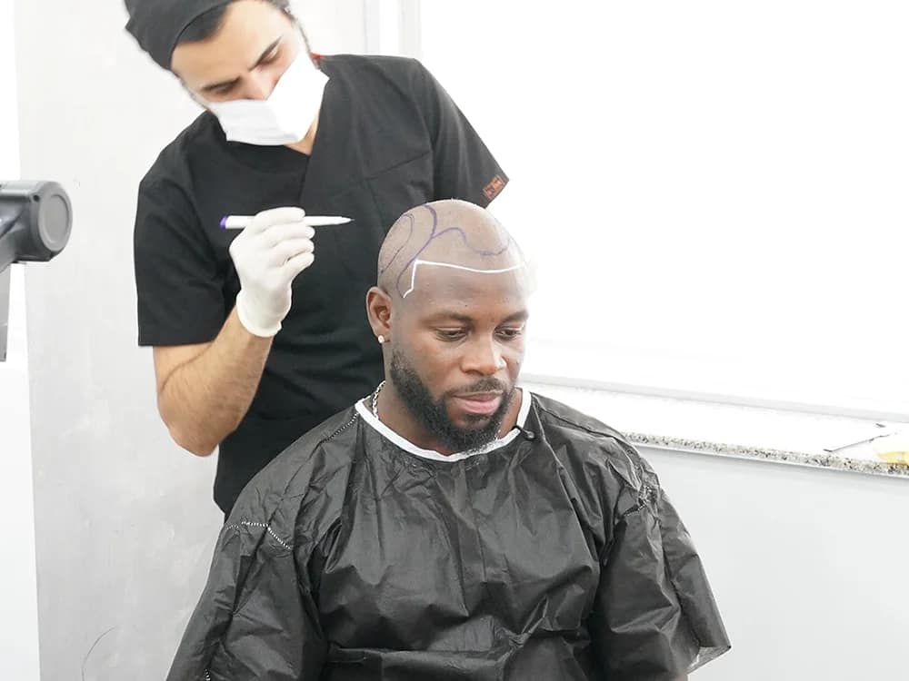 Greffe de Cheveux de Noé D’Almeida en Turquie 6 Préparation de l’intervention de greffe de cheveux de Noé à Istanbul